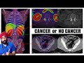 PET CT Scan can detect any and all CANCER in your Body | Dr.Education