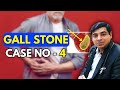 Gallbladder Stone Case No 4 | Homeopathy Treatment for Gallbladder stone | Dr Abhik Ghosh