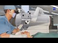 SMILE pro laser eye surgery with the ZEISS Visumax 800