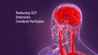 IPR Therapy Overview