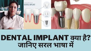 Dental Implant क्या होता है? जानिए सरल भाषा में||what is dental implant||dental implant kya hota hai