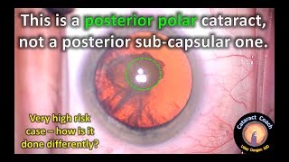 Posterior Polar Cataract Surgery - keys to success