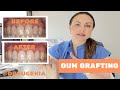 What is Gum Grafting with Dr. Eugenia