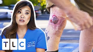 Patient Suffers From A Large Bump That's Growing Out Of Control | Dr Pimple Popper