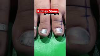 Kidney stone | Viddhakarma | Dr chandrakumar