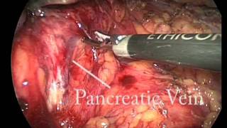 Bad Video - Laparoscopic Distal Pancreatectomy Complicated By Renal Injury