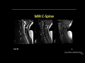 Neuroradiology spine lesions - Case 2 - overview - Choose your own adventure