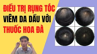 Điều Trị Viêm Da Dầu Với Hoa Đà Trị Rụng Tóc #3
