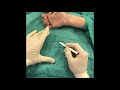 Complex dorsal dislocation MCP joint little finger- clinical, radiological & surgical outcome