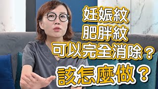 想要消除妊娠紋、肥胖紋嗎？莊盈彥醫師告訴你如何預防及治療妊娠紋！