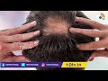 బట్టతల మాయం చేయడానికి అద్భుతమైన టెక్నిక్ japanese researchers found cure for baldness 10tv news