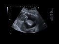 beautiful ultrasound video of 14 weeks pregnancy baby girl