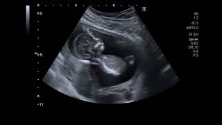 Beautiful Ultrasound Video of 14 Weeks Pregnancy| Baby Girl