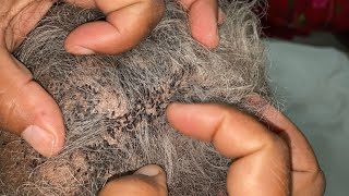 #nitsremoval wife removed husband lices super video || long hair lice picking with hands 🙌 ||part48