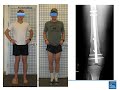 Dr. Rozbruch Discusses Knock-Knee Treatment