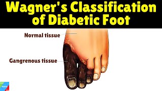 Wagner's Classification of Diabetic Foot