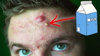 THAT'S A DAIRY PIMPLE | Derms Won't Tell You This