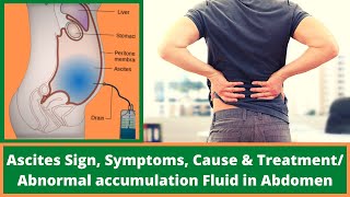 Ascites Sign, Symptoms, Cause \u0026 Treatment/ Abnormal accumulation Fluid in Abdomen