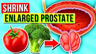 9 TOP Foods & Vitamins To Shrink An ENLARGED PROSTATE