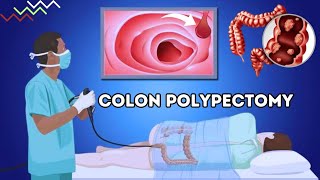 Colon Polypectomy | Removal Of Polyps From Large intestine (Urdu/Hindi)