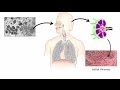 mpox monkeypox transmission pathophysiology signs u0026 symptoms diagnosis treatment