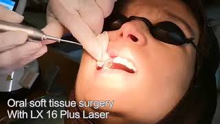 Oral soft tissue surgery with Laser LX16