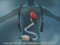 heartmate ii left ventricular assist system mylvad