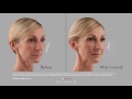 tami s story with juvÉderm voluma® xc