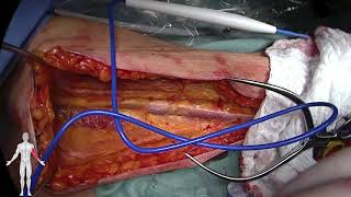 Arteriovenous Fistula Creation - Brachiobasilic Transposition (Eric Peden, MD, M. Mujeeb Zubair, MD)