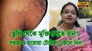 ছুলি থেকে মুক্তি পেতে চান? সহজ ও ঘরোয়া টোটকা জেনে নিন। | EP 99