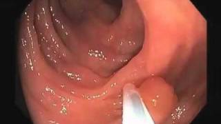 Colonoscopy Video Tour: Removal of a Colon Polyp (Polypectomy)