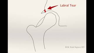 (Old Version) Dr. Raynor explains FAI and hip labral tears