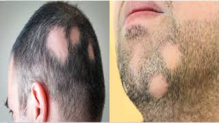 Alopecia Areata: Causes, And Treatment ಈ ರೀತಿಯ ಸಮಸ್ಯೆಗಳು ನಿಮಗೂ ಇದಿಯೇ ?ಹಾಗಿದ್ದರೆ ಈ ವಿಡಿಯೋ ನೋಡಿ.