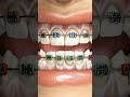 how to process fix extremely crooked teeth braces orthodontist orthodox