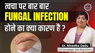 Fungal Infection on Skin | Complete Treatment of Fungal Infections | फंगल इन्फेक्शन का पूरा इलाज