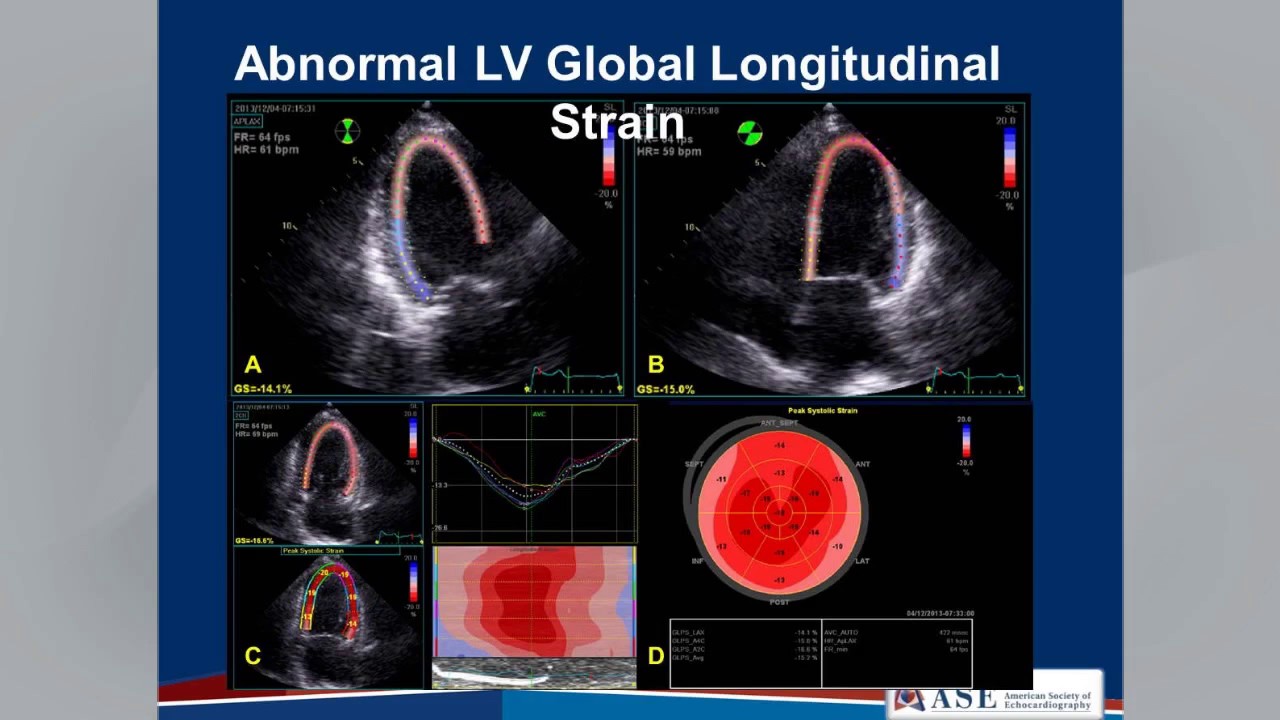 Echocardiographic Assessment Of Lv Diastolic Function Webinar Youtube