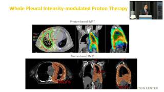 Radiation therapy for mesothelioma | 2022 International Symposium on Malignant Mesothelioma