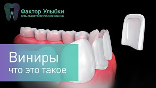 Виниры - что это такое и как их устанавливают!