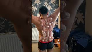 Cupping therapy loosening the whole back satisfying sound #shorts