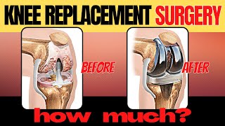 When to Consider Knee Replacement if you have Osteoarthritis | Doc Cherry