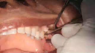 Live - grossly decayed second molar extraction by dr.c.murugavel