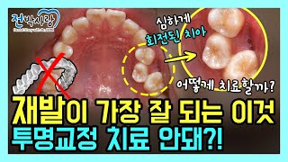 1-75. 심하게 회전된 치아!!! 투명교정으로 안돼???