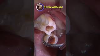 Cleaning Up Occlusal Decay on Tooth #31 #dentalshorts