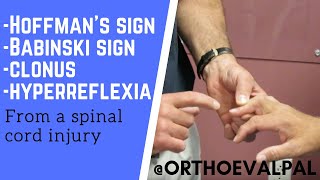 Positive Hoffman's sign and Babinski test, clonus, hyperreflexia in a C5-6 injury