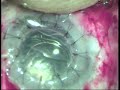 deep anterior lamellar keratoplasty dalk with manual sics a variation of triple procedure