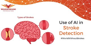 Case Study I AI-Powered Stroke Detection
