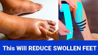 HOW to GET RID of Swollen Feet and Swollen Ankles Fast | Kinesio Tape for Ankle Swelling