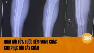 Đinh nội tủy: Phương pháp tốt nhất - bước đệm vững chắc giúp phục hồi gãy chân | Toàn cảnh 24h