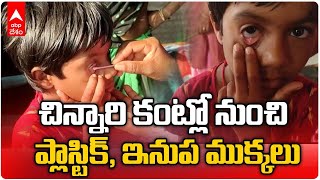 Plastic Coming From Girl Eye |వింత ఘటన..చిన్నారి కంట్లో నుంచి బయటపడుతున్న ఇనుప ముక్కలు | DNN | ABP