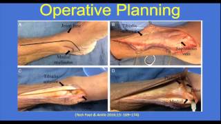 Managing open distal tibia fractures: tips and tricks